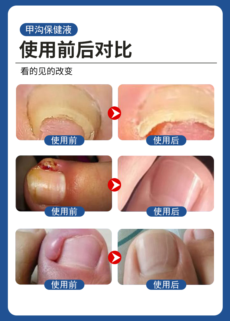 甲溝炎專用液有用嗎？使用前后對(duì)比
